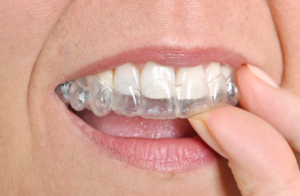 invisalign for adults